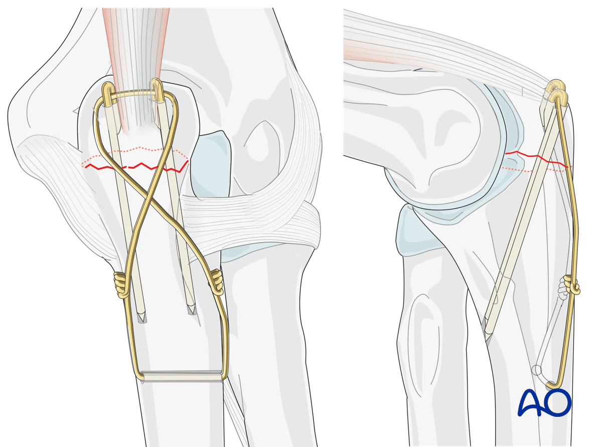 Cerclage compression wiring of an olecranon fracture