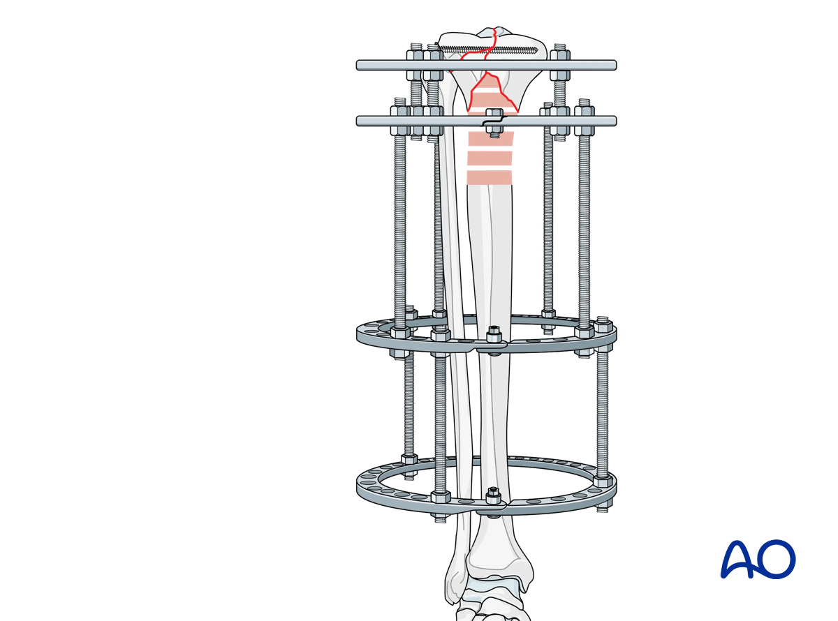 Proximal tibia fracture – ring fixation: frame assembly