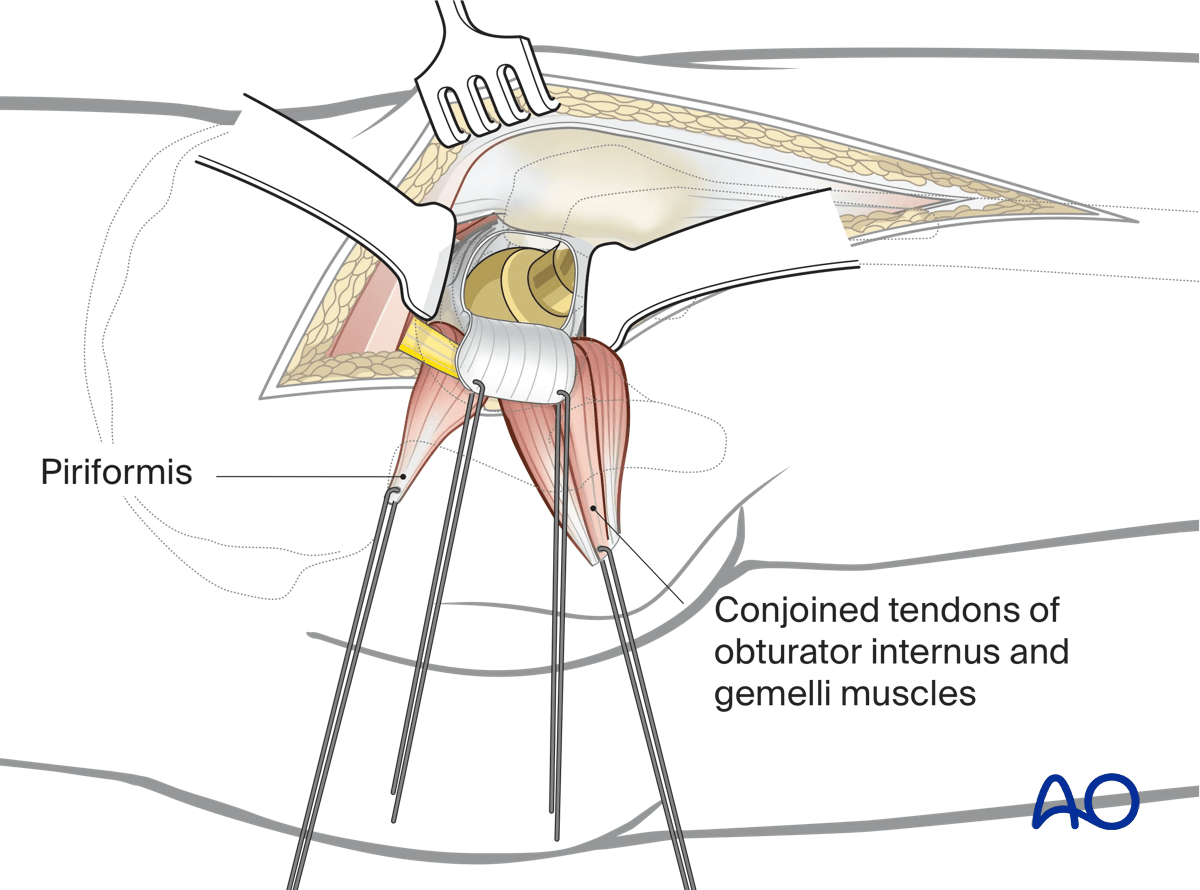 Hip joint exposure in a Kocher-Langenbeck approach