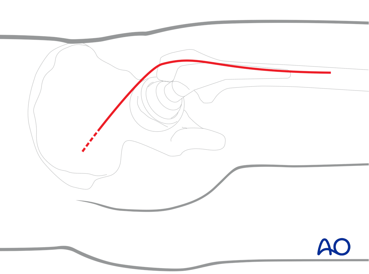 Skin incision for Kocher-Langenbeck approach to the hip