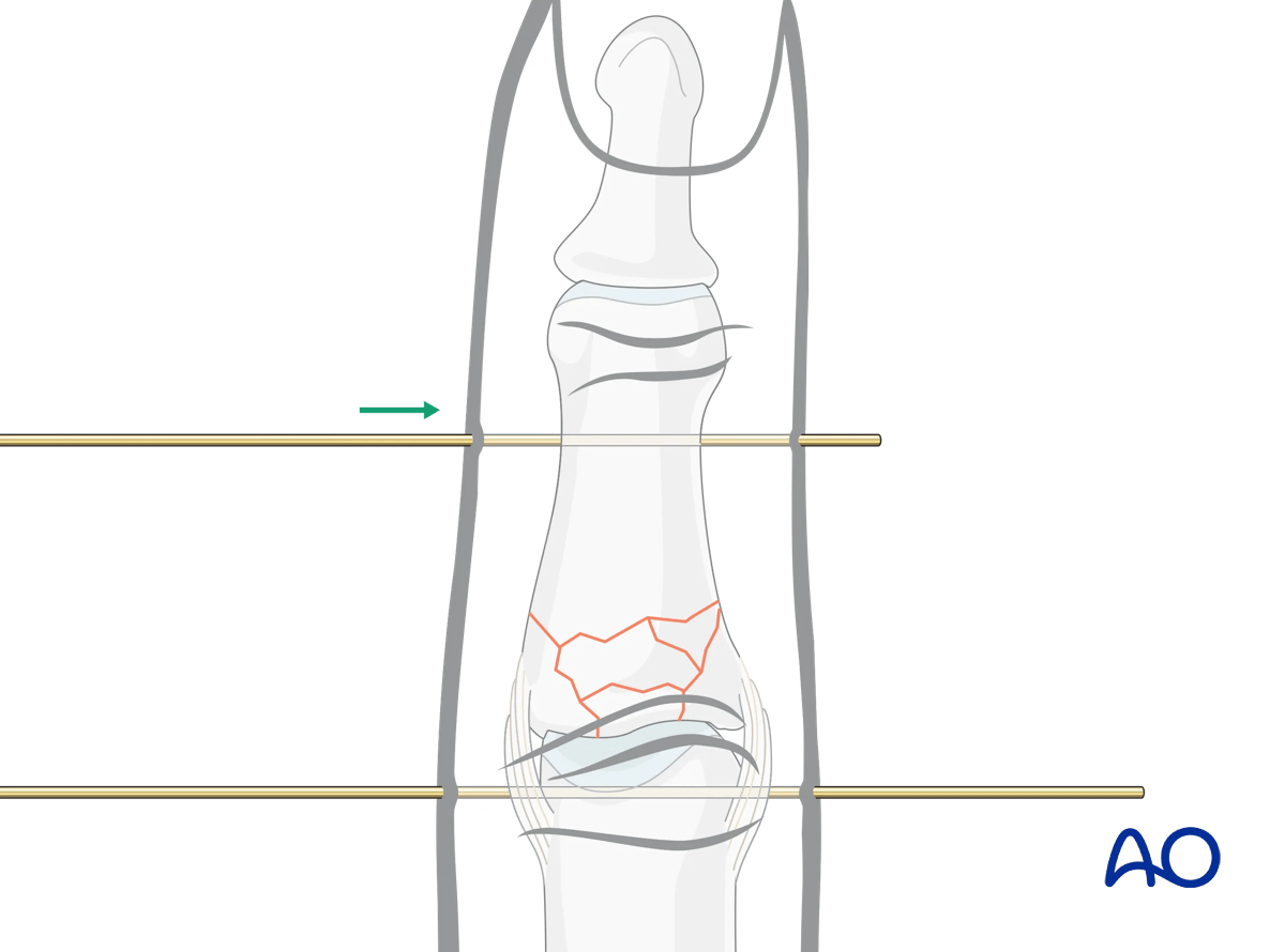 Dynamic external fixation: Insert second K-wire distal to fracture up to condyles of middle phalanx parallel to first K-wire.