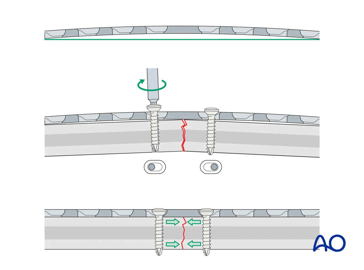 Illustration showing an overbent plate standing off 1-2 mm from the fracture surface, acting as a spring to provide compression at the far cortex after fixation.