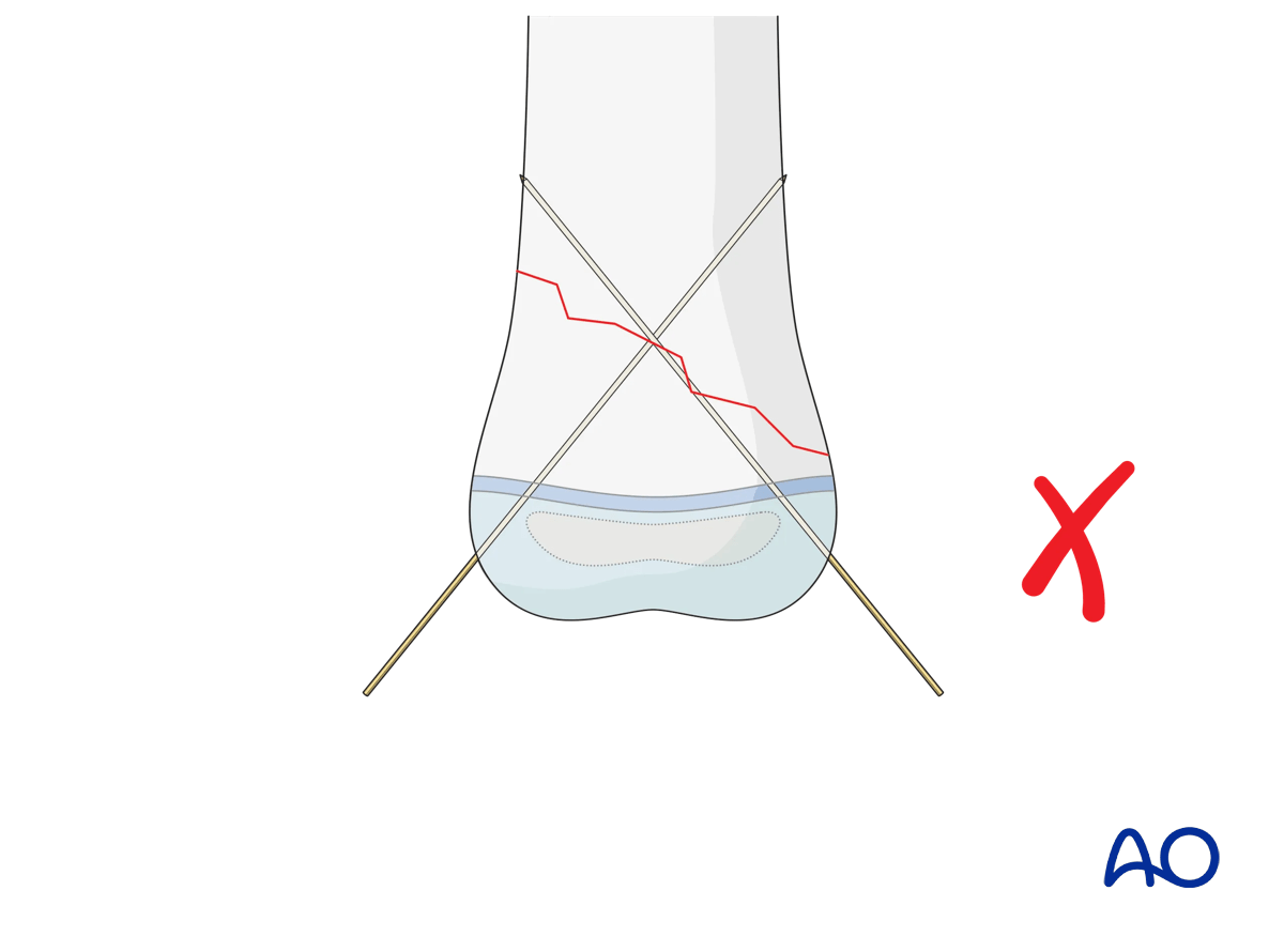 Crossed K-wire fixation with nearly parallel K-wire to oblique fracture plane