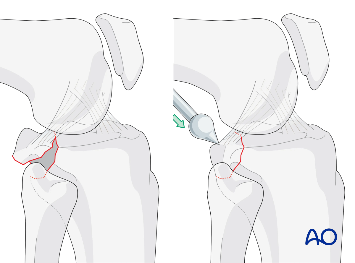 Posterior cruciate avulsion - Ligamentotaxis