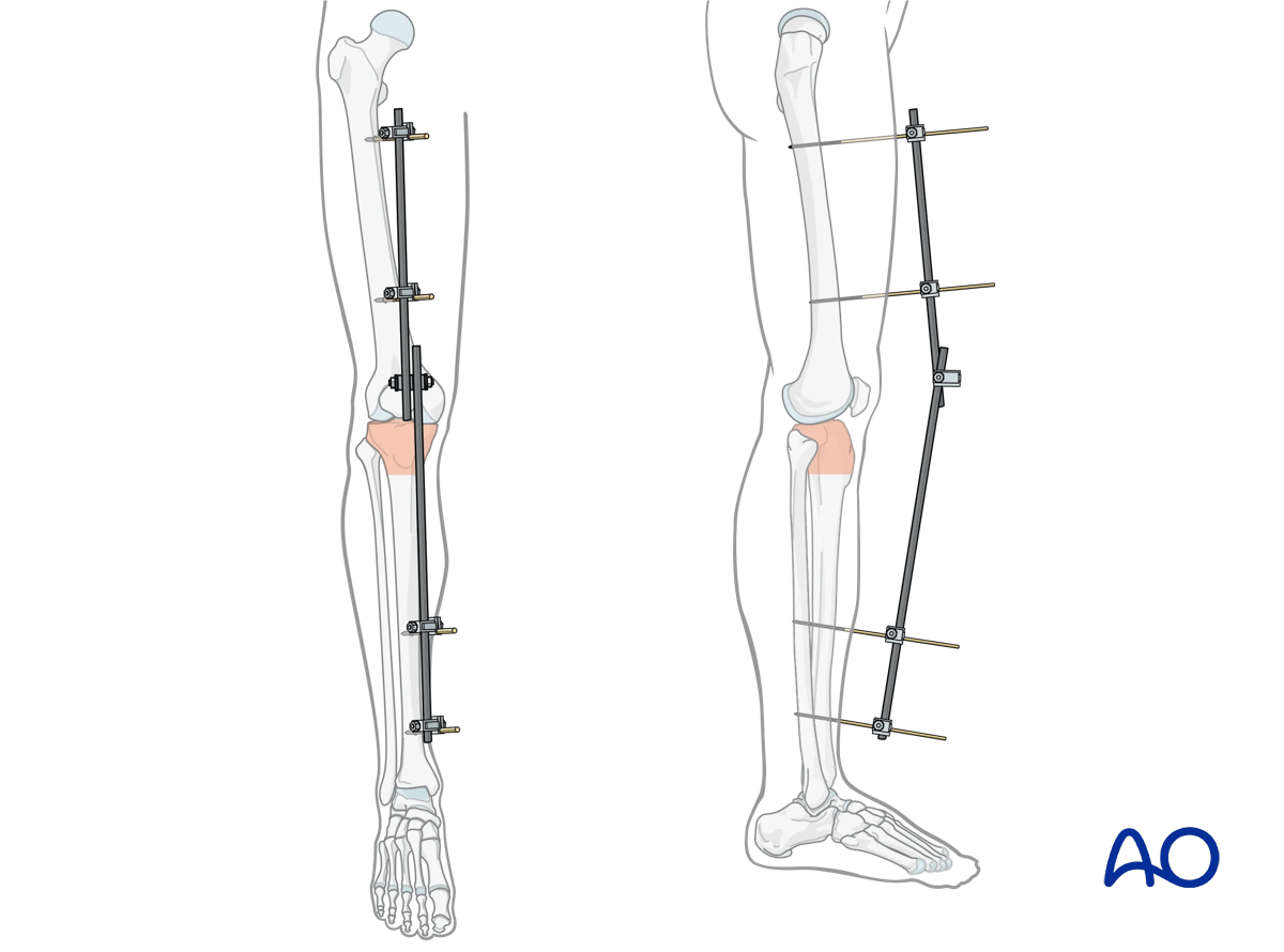 Proximal tibia fracture: temporary joint-bridging external fixation