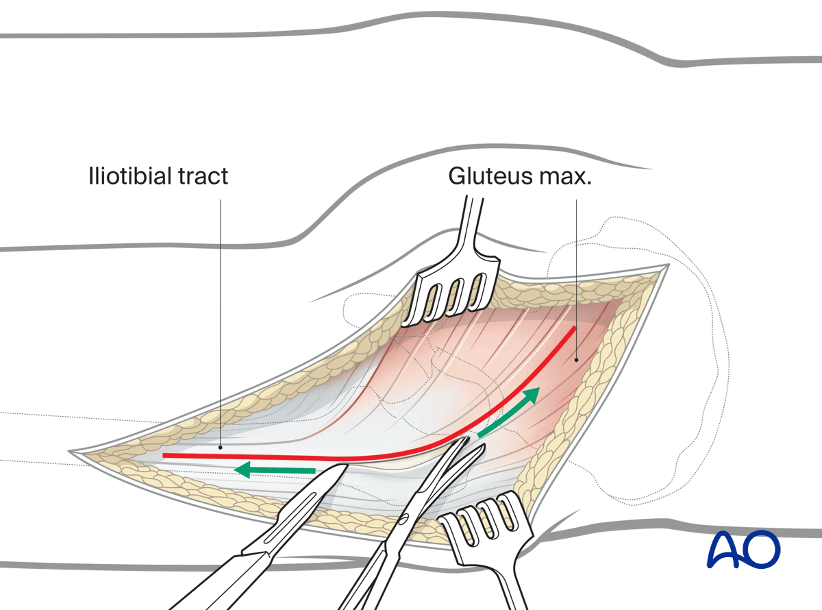 Sharply incise subcutaneous tissues along gluteus maximus muscle with scissors and iliotibial tract with scalpel.