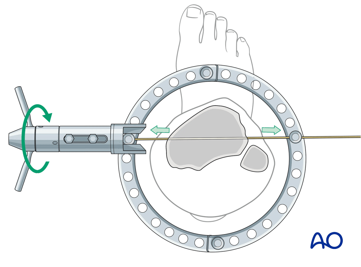 Proximal tibia fracture – ring fixation: tensioning a wire secured to the articular ring