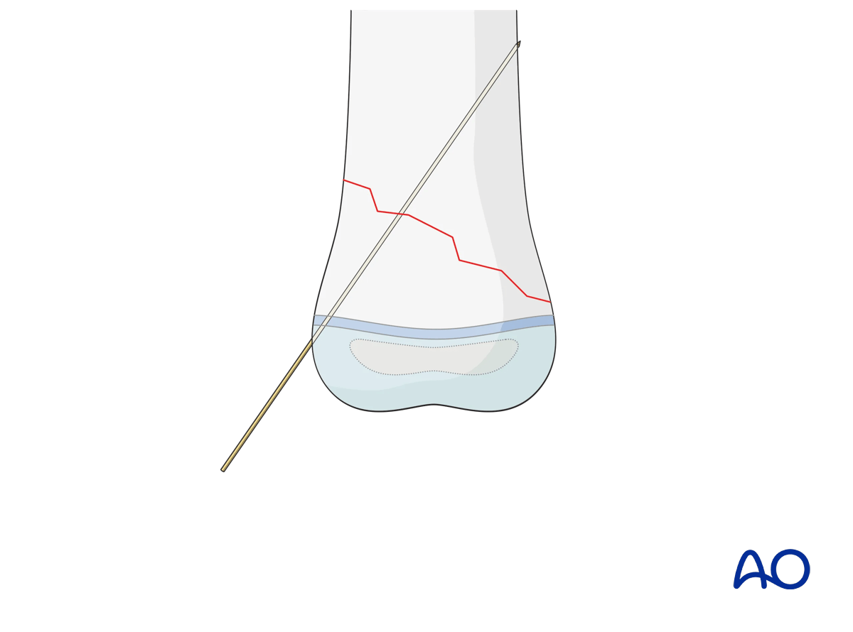 K-wire fixation of an oblique metaphyseal fracture in a pediatric patient
