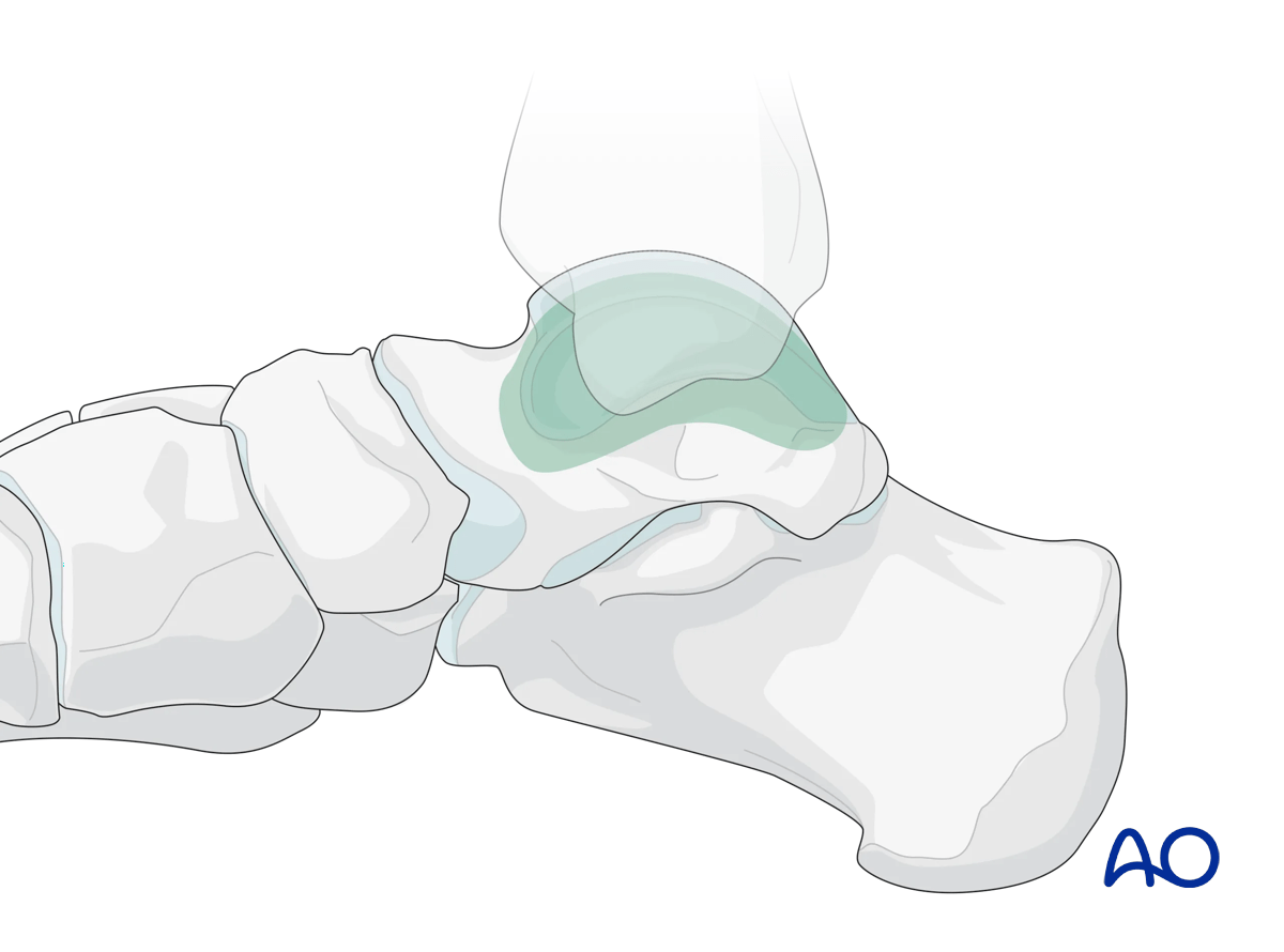 Areas of the talus visible using the Medial malleolar osteotomy