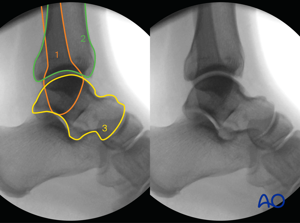 Lateral intraoperative view of the ankle with landmarks and lines