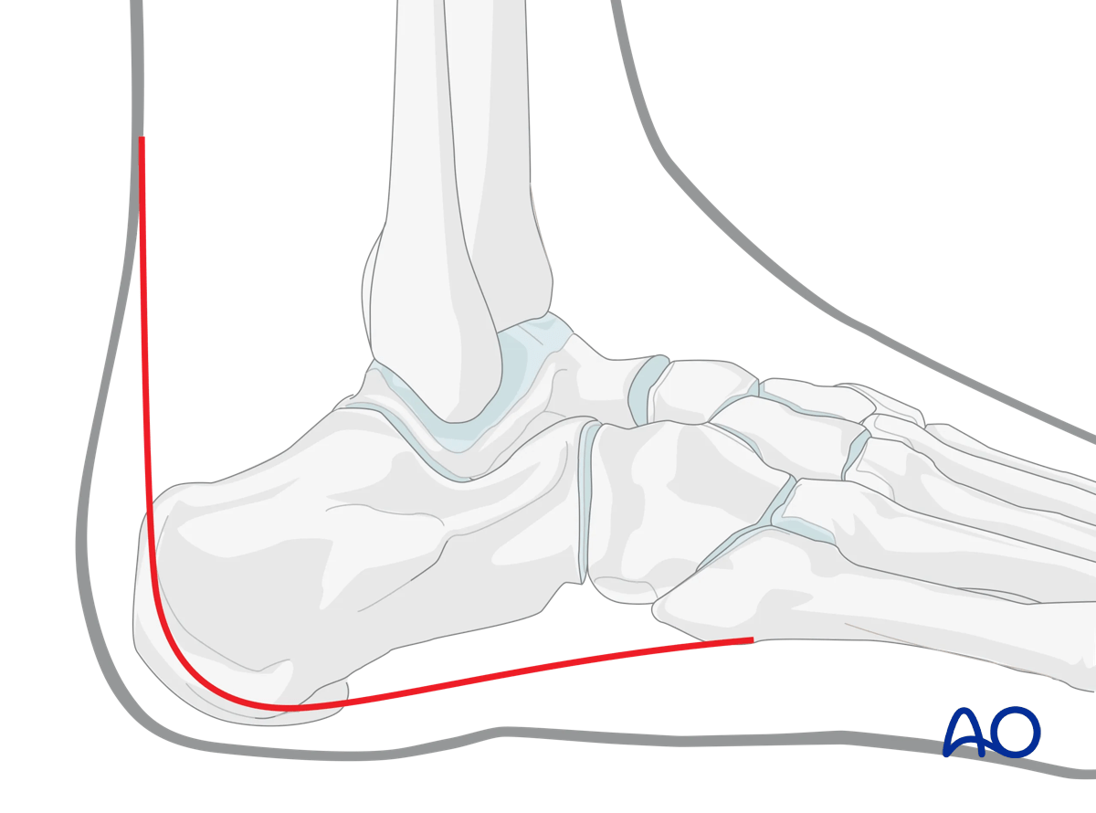 Extended lateral approach to the calcaneus: versatile fixation approach; careful incision to avoid wound issues