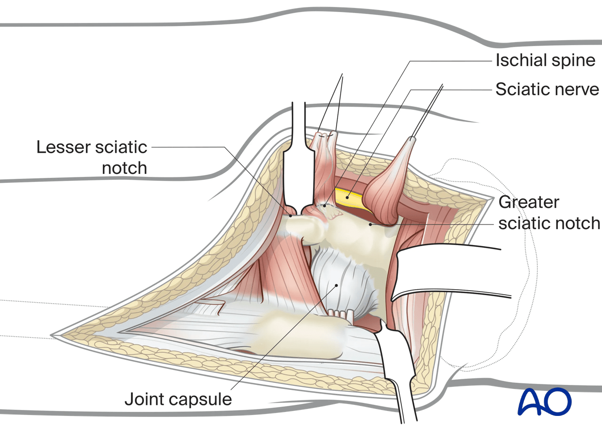 Illustration of Kocher-Langenbeck approach: exposing sciatic notches and protecting sciatic nerve with sponges.