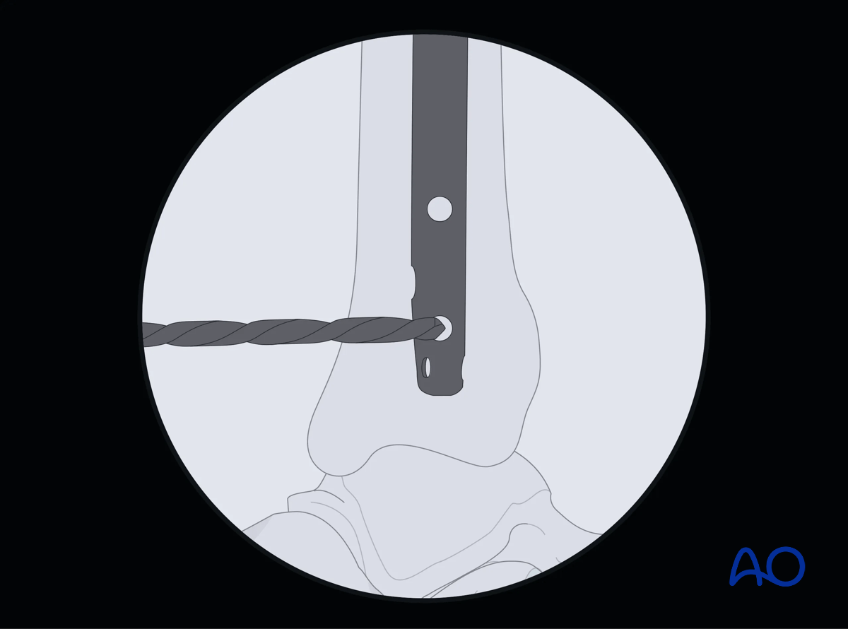 Suprapatellar intramedullary nailing, Distal interlocking with fluoroscopic guidance