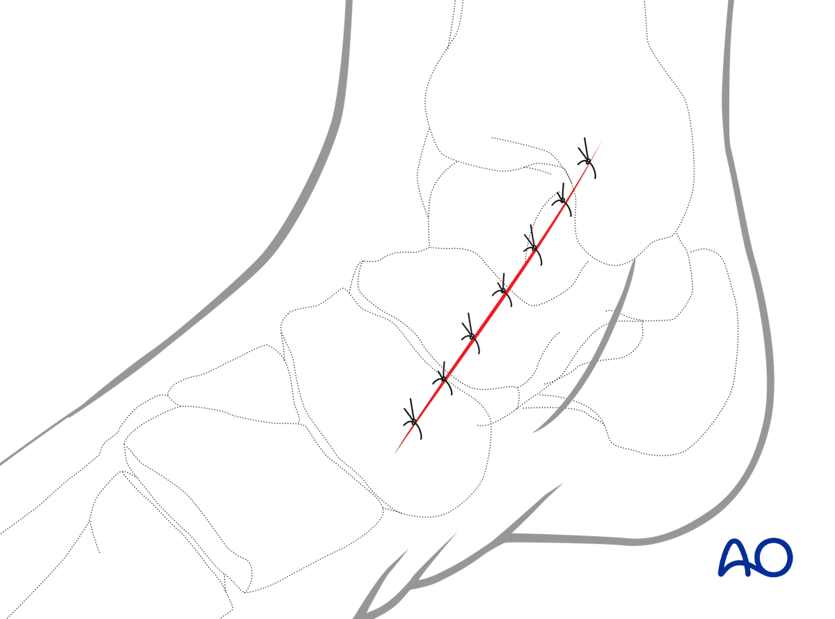 Anteromedial approach wound closure in two layers