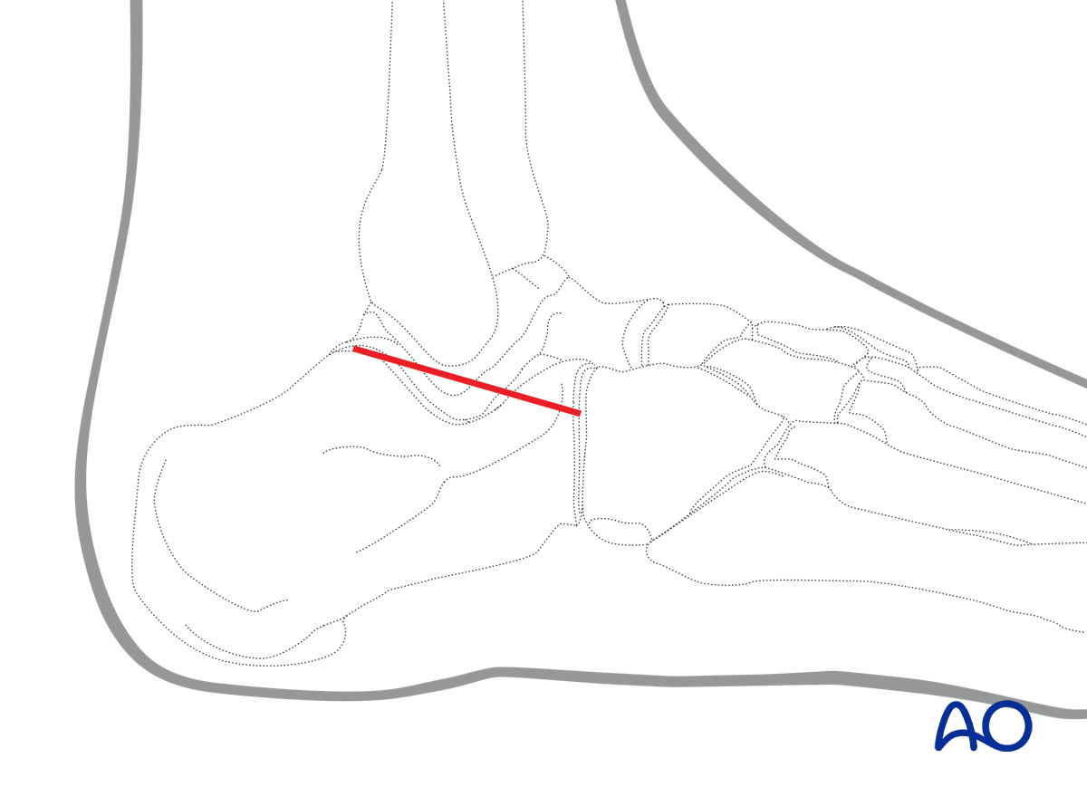 Sinus tarsi approach to the calcaneus for displaced intraarticular fracture fixation with adjunct reduction