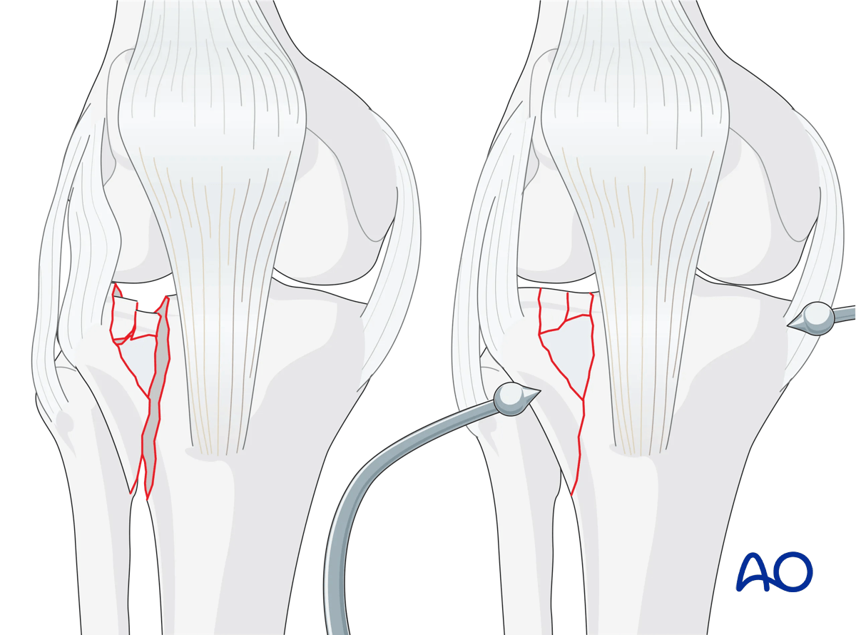 Proximal tibia Lateral plateau split-depression fracture – ORIF conventional plating – preliminary reduction