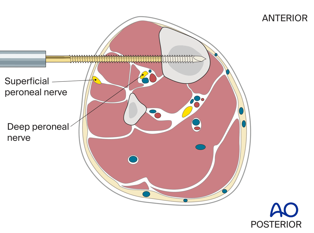Anterolateral approach to the proximal tibia: application of the universal distractor