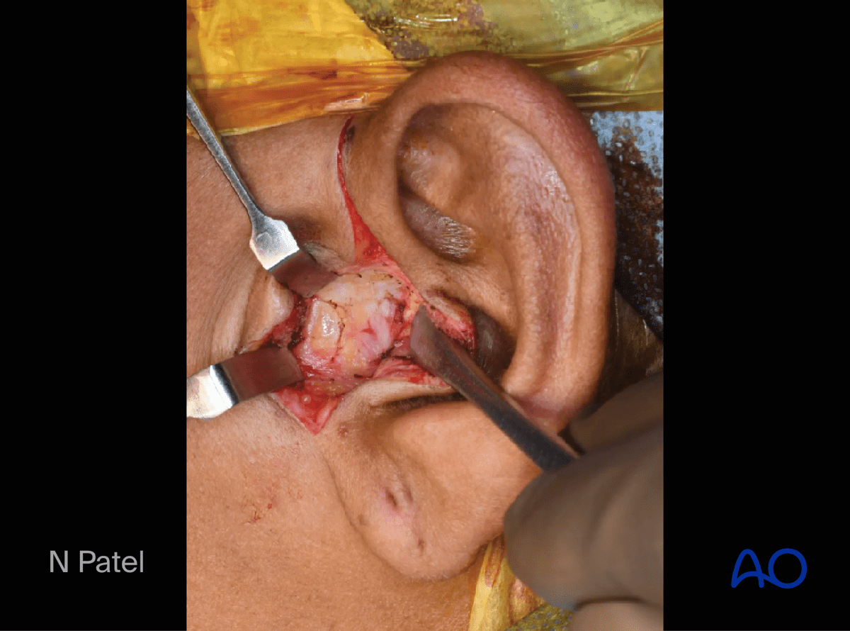 Endaural approach to condyle: Carry the incision through the skin and subcutaneous tissue to expose the tragal cartilage at the supra-perichondrial level.