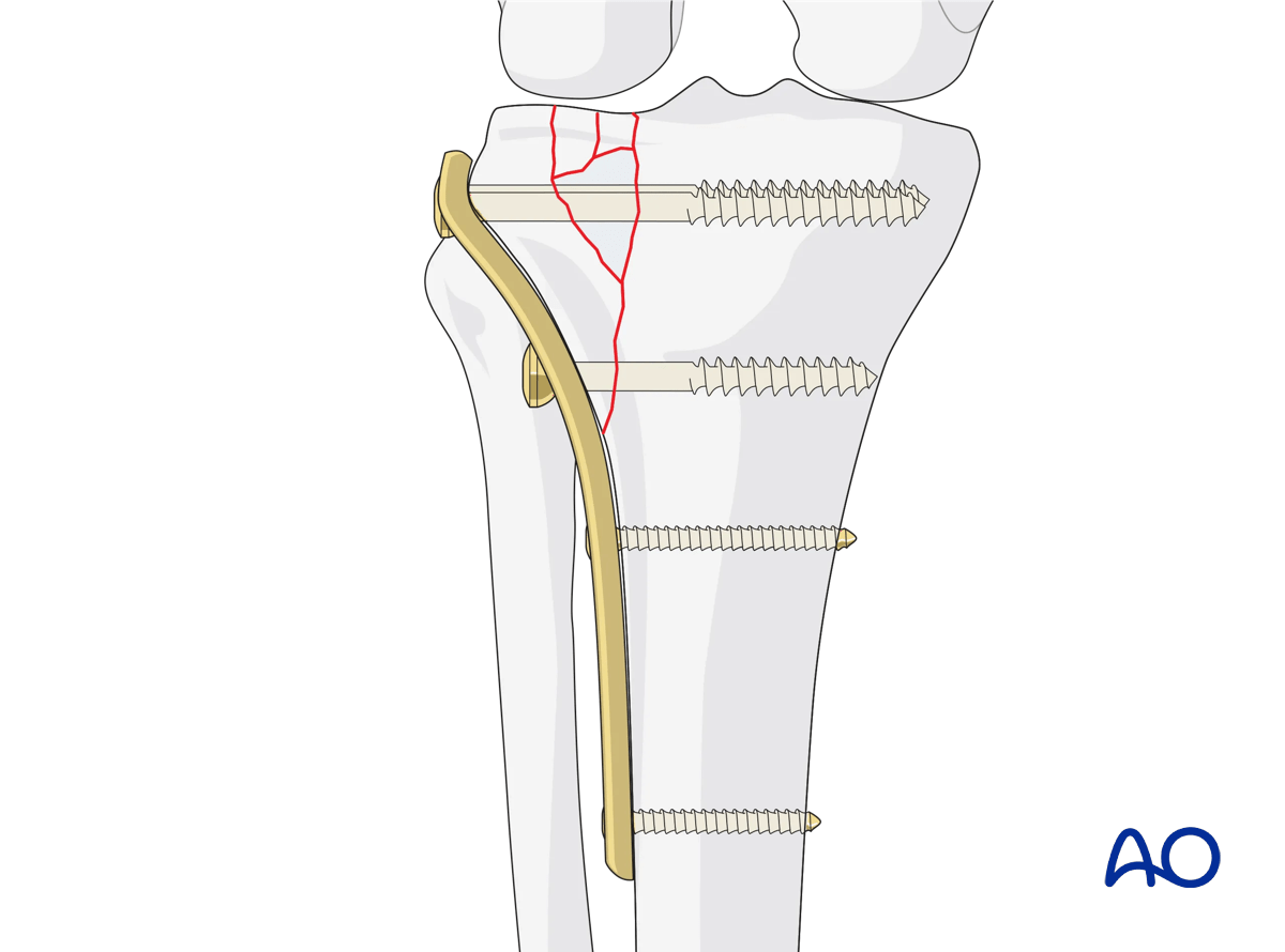 Proximal tibia Lateral plateau split-depression fracture – ORIF conventional plating – final construct
