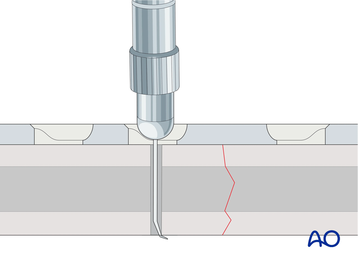 Determination of screw length