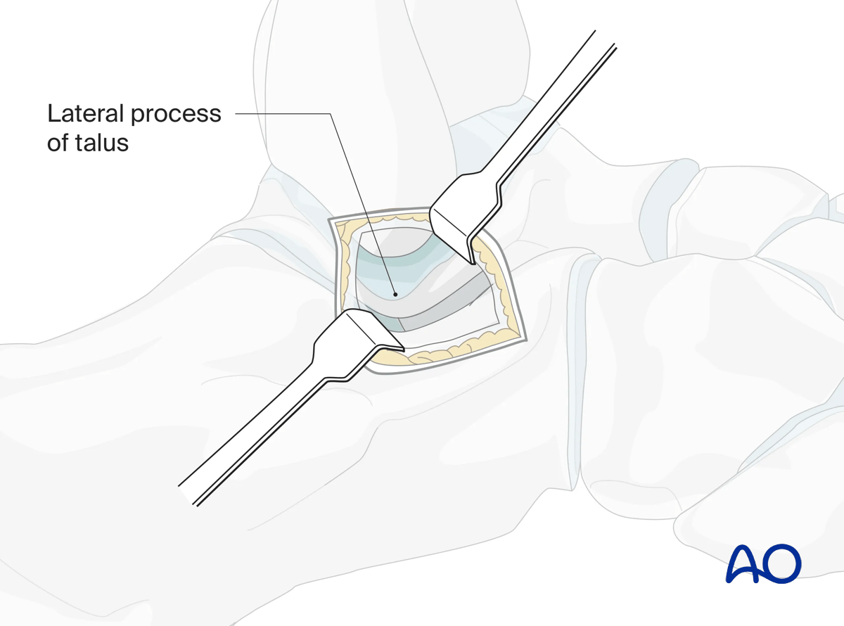 Direct lateral talus approach deep fascia opened; fat pad incised to expose subtalar capsule and lateral talar process