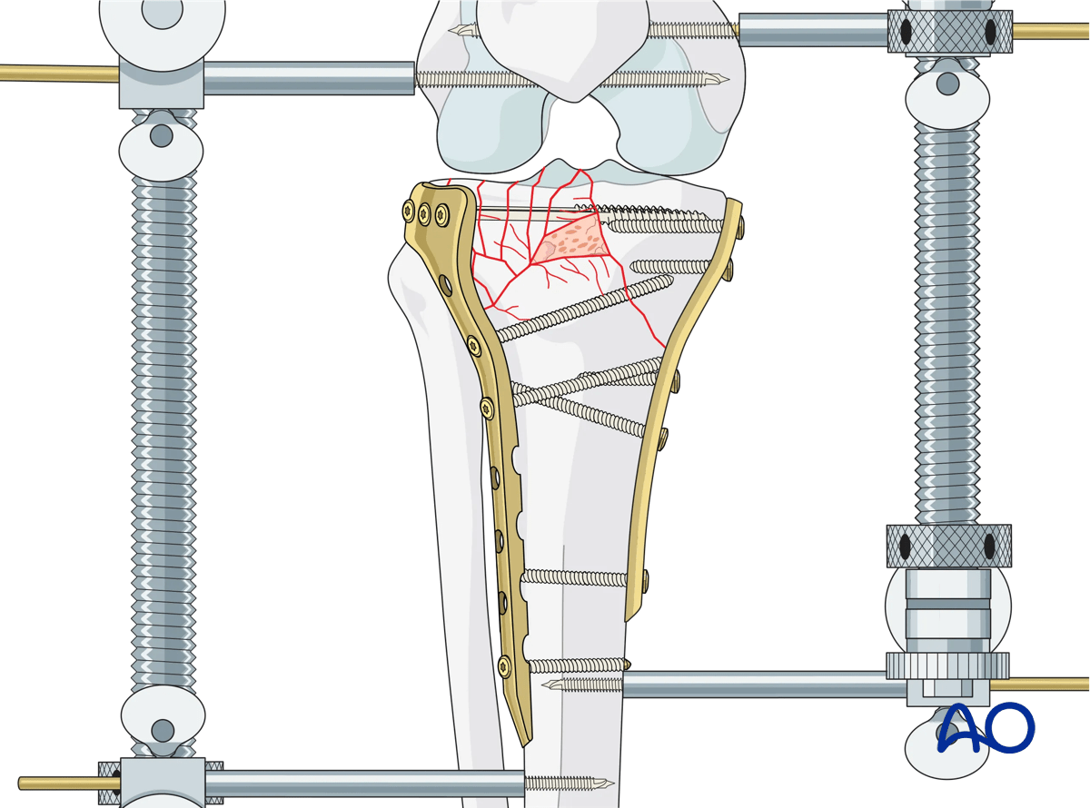 ORIF - Conventional plating, fixation of lateral column