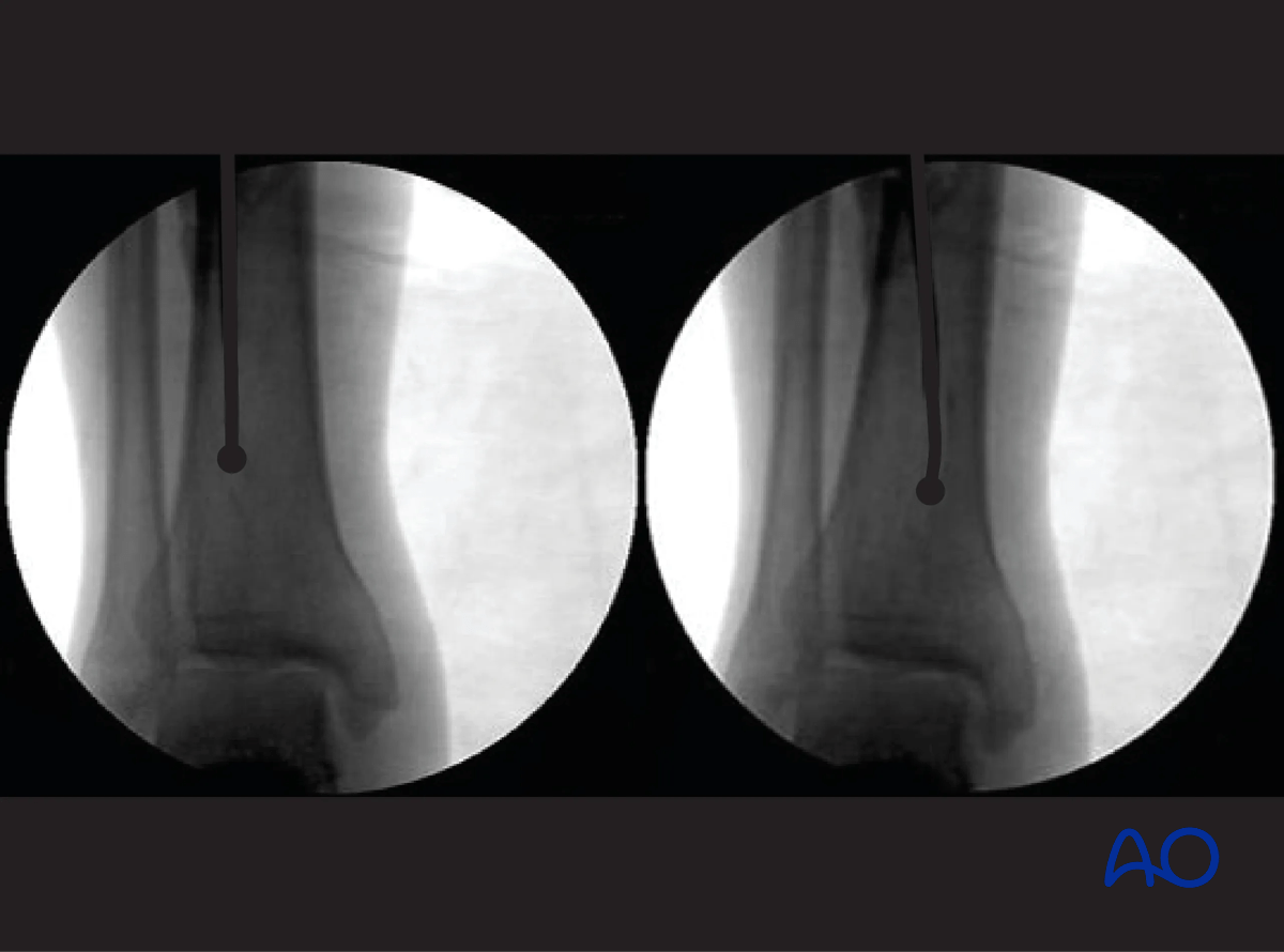 Tibia intramedullary nailing - bending the guide wire