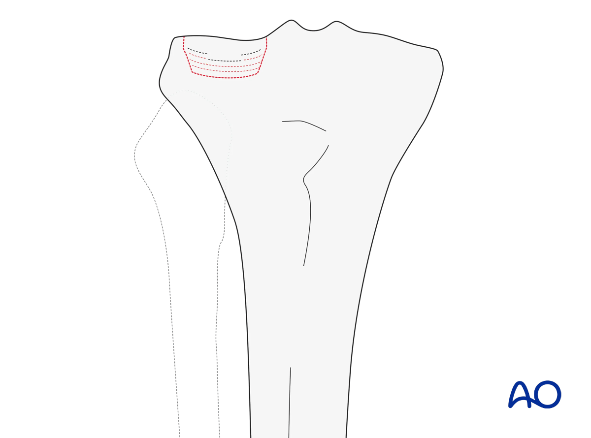 Partial articular fracture, depression (AO/OTA 41B2)
