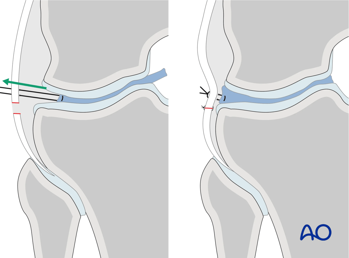 Anterolateral approach to the proximal tibia: arthrotomy