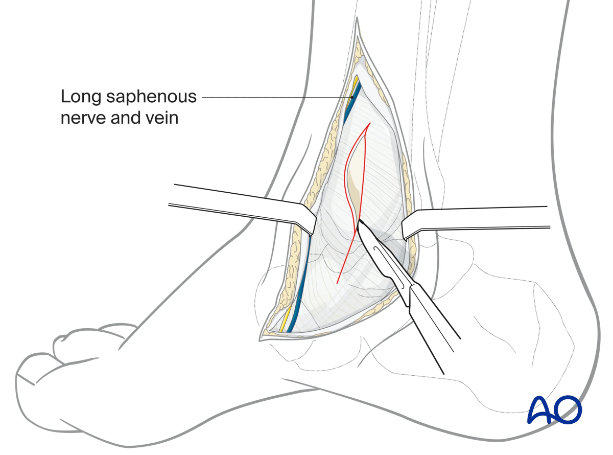 Protect saphenous nerve/vein; incise periosteum/capsule to landmark for medial malleolar osteotomy.