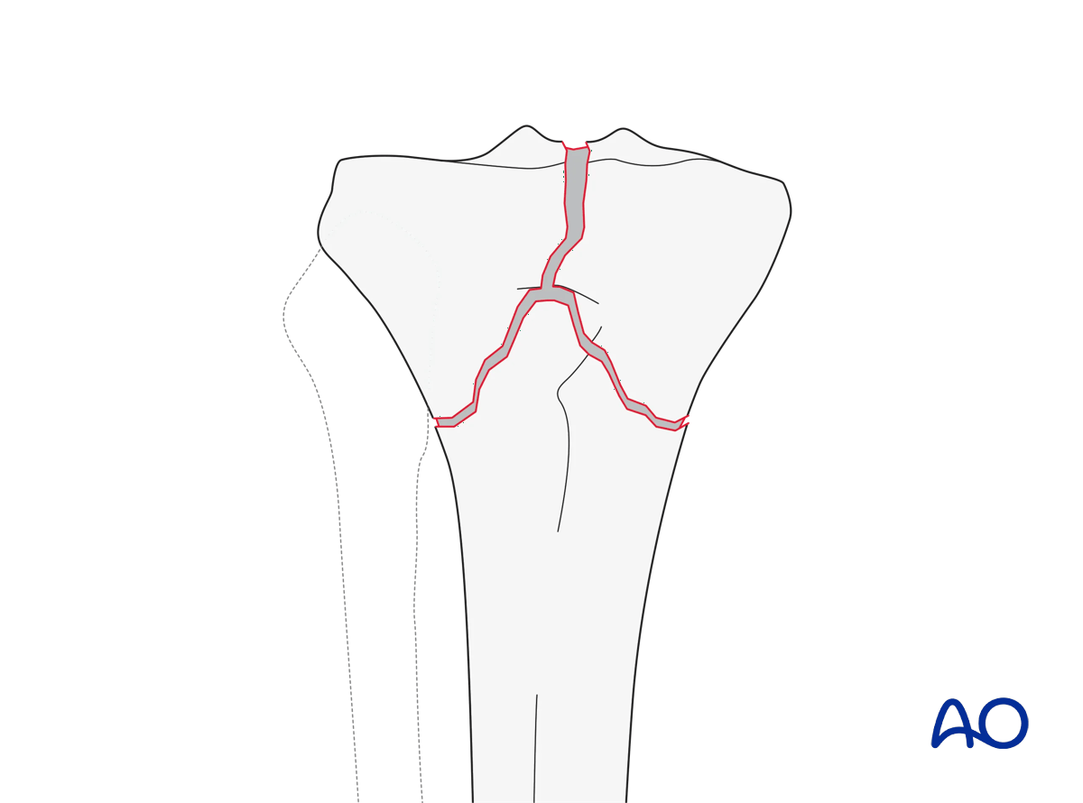 Complete articular fracture, simple articular, simple metaphyseal (AO/OTA 41C1)