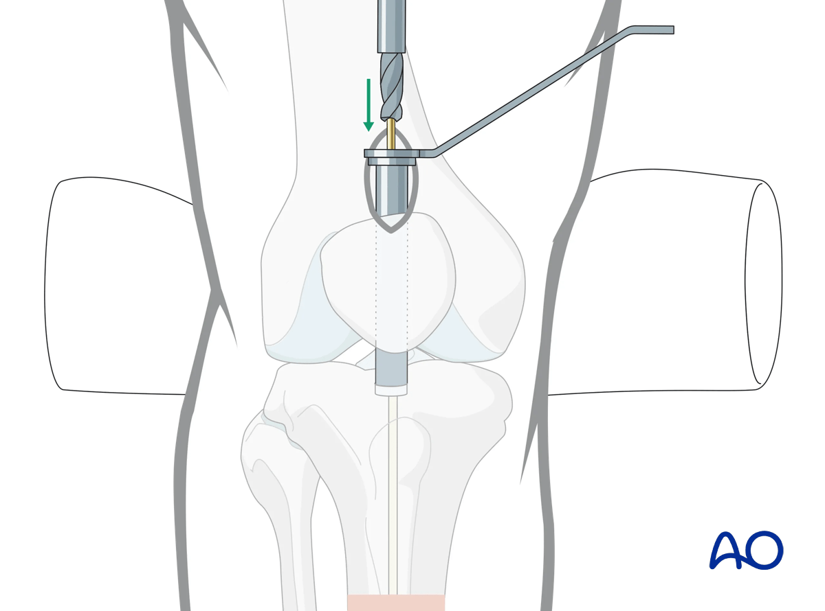 Suprapatellar intramedullary nailing, Opening the cortex and proximal tibia
