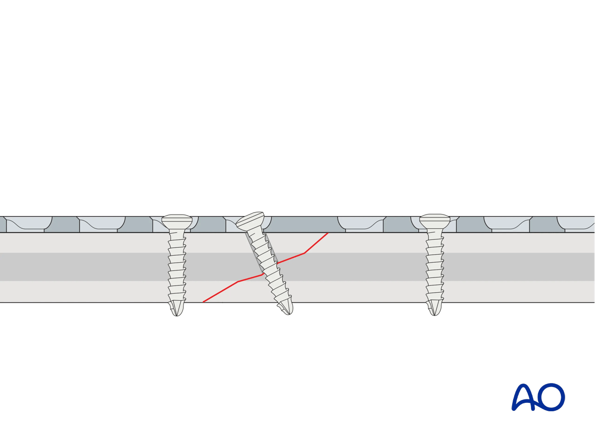 Illustration showing lag screw insertion through the plate to provide additional compression.