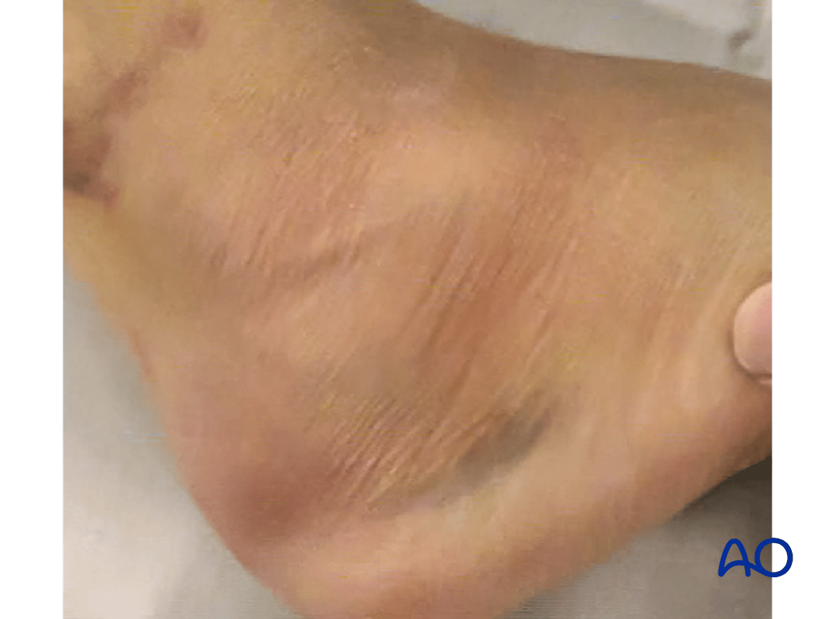 Sinus tarsi approach to the calcaneus showing wrinkle sign guiding timing of surgery