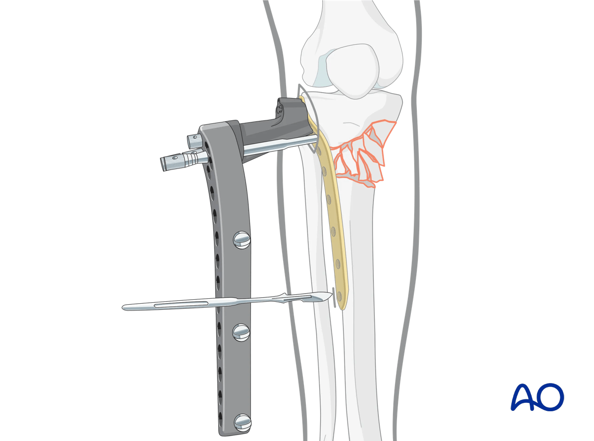 Proximal tibia: Wedge or multifragmentary extraarticular fracture Angular stable plating – plate positioning