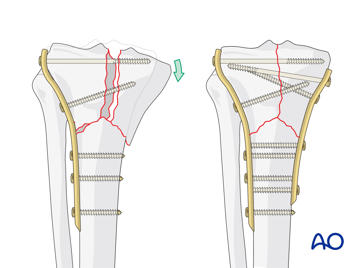 Complete simple articular fracture with simple metaphyseal components: ORIF Conventional plating – double plating
