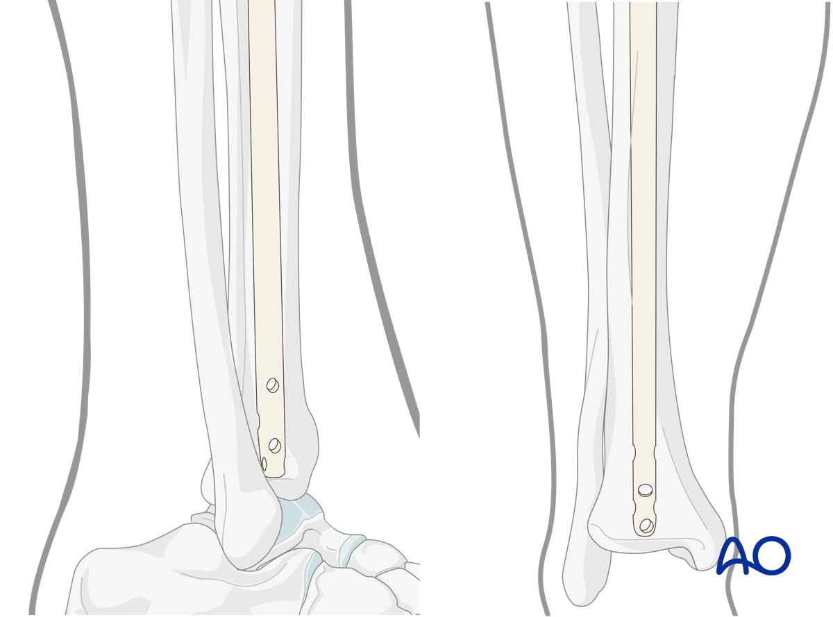 Suprapatellar intramedullary nailing, Insertion of the cannulated nail