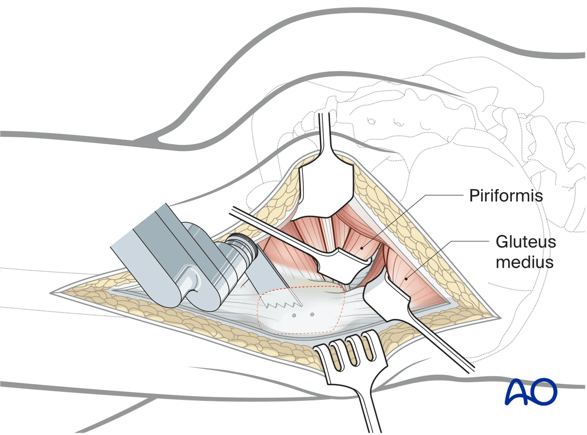 Illustration of Kocher-Langenbeck approach: predrilling trochanter, performing osteotomy, and mobilizing fragment.