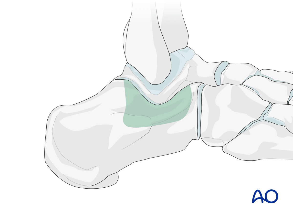 Sinus tarsi approach to the calcaneus showing calcaneus areas visualized through the approach