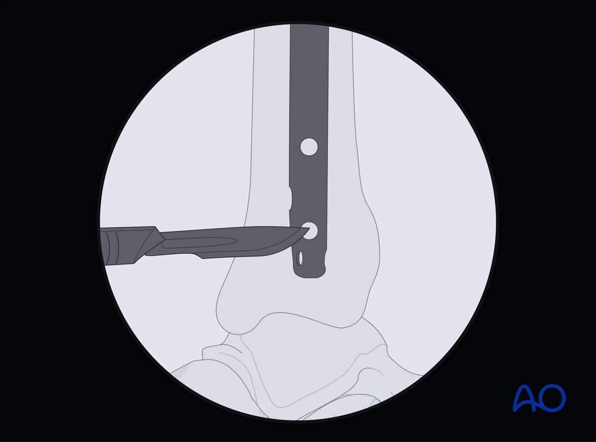 Suprapatellar intramedullary nailing, Distal interlocking with fluoroscopic guidance