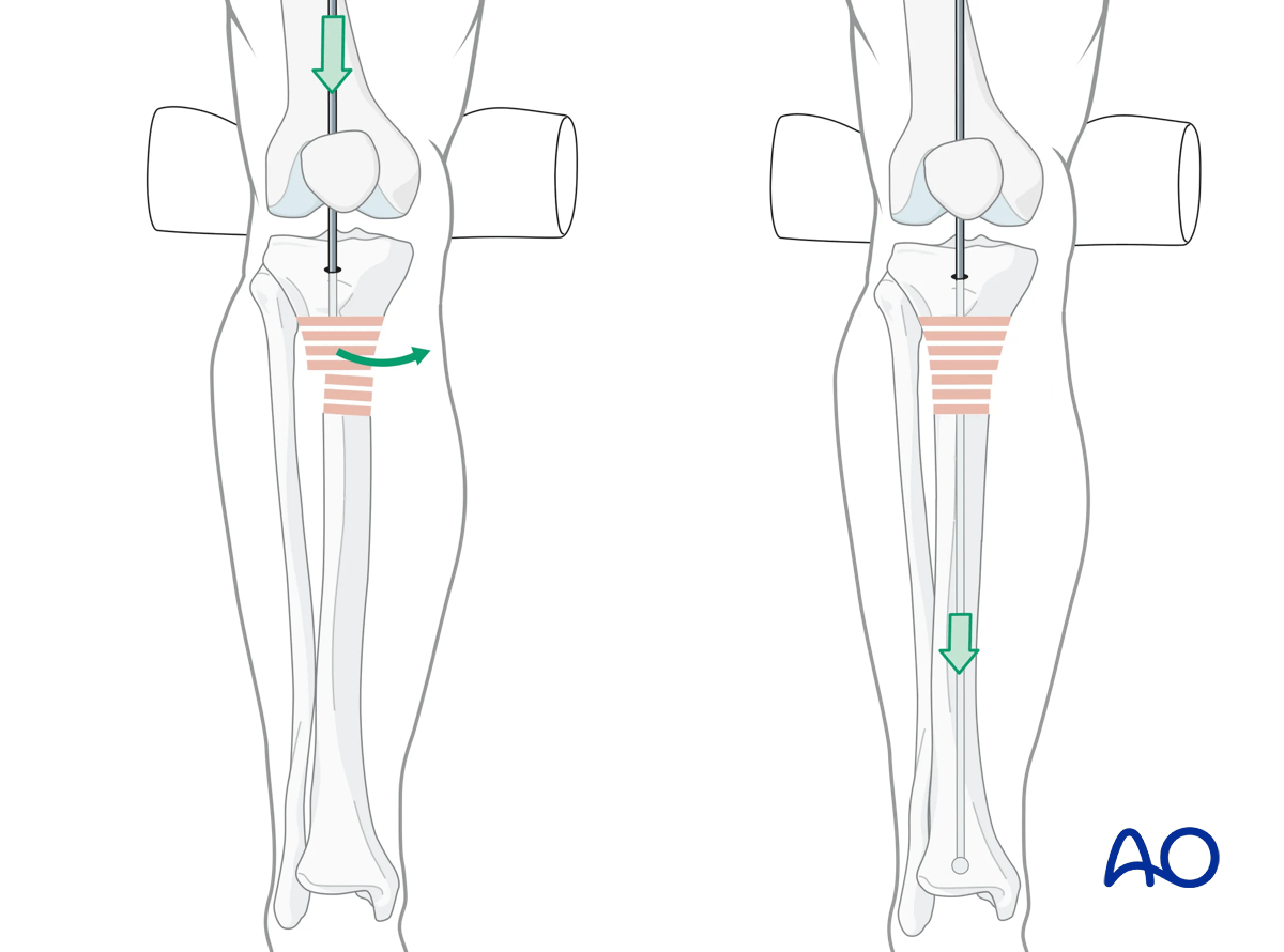 Suprapatellar intramedullary nailing, ball-tipped guide wire insertion
