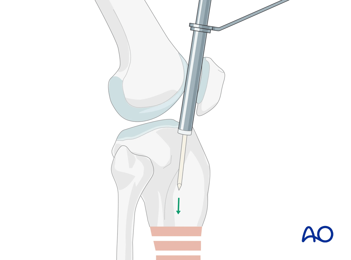 Suprapatellar intramedullary nailing, insertion of the guide wire