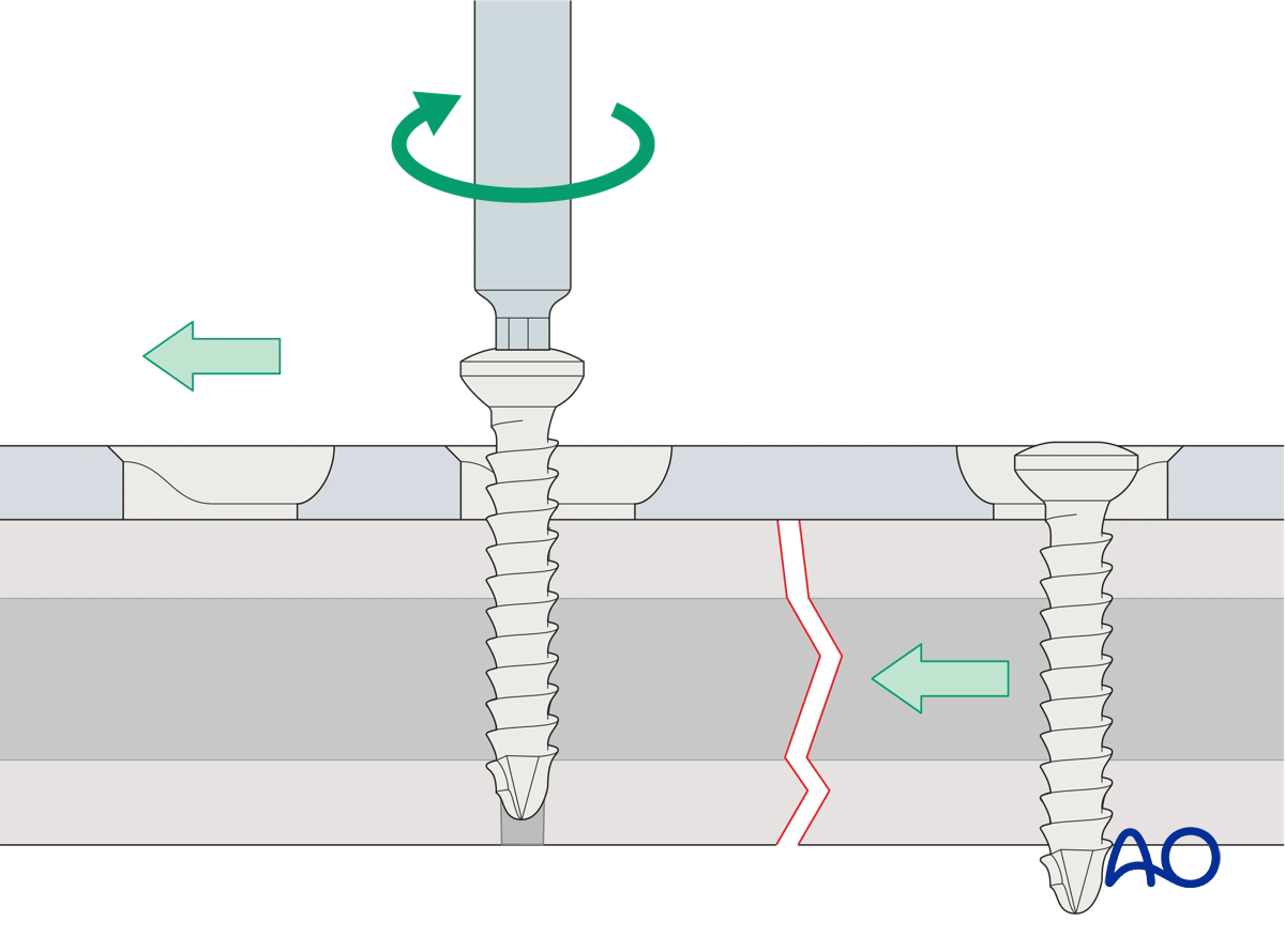 Compression of fracture