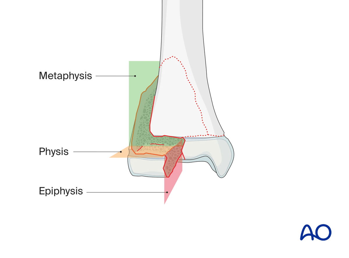 Triplane fracture of the pediatric distal tibia