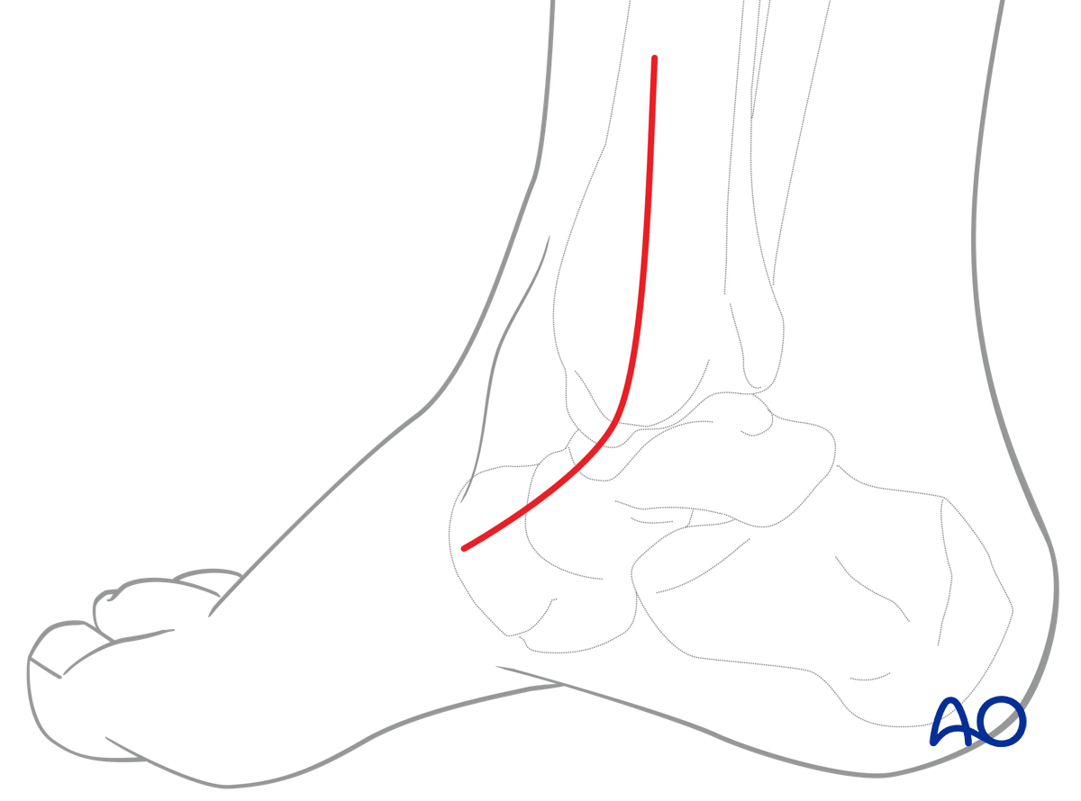 Medial malleolar osteotomy: Longitudinal incision over distal tibia/medial malleolus, extended toward 1st metatarsal.