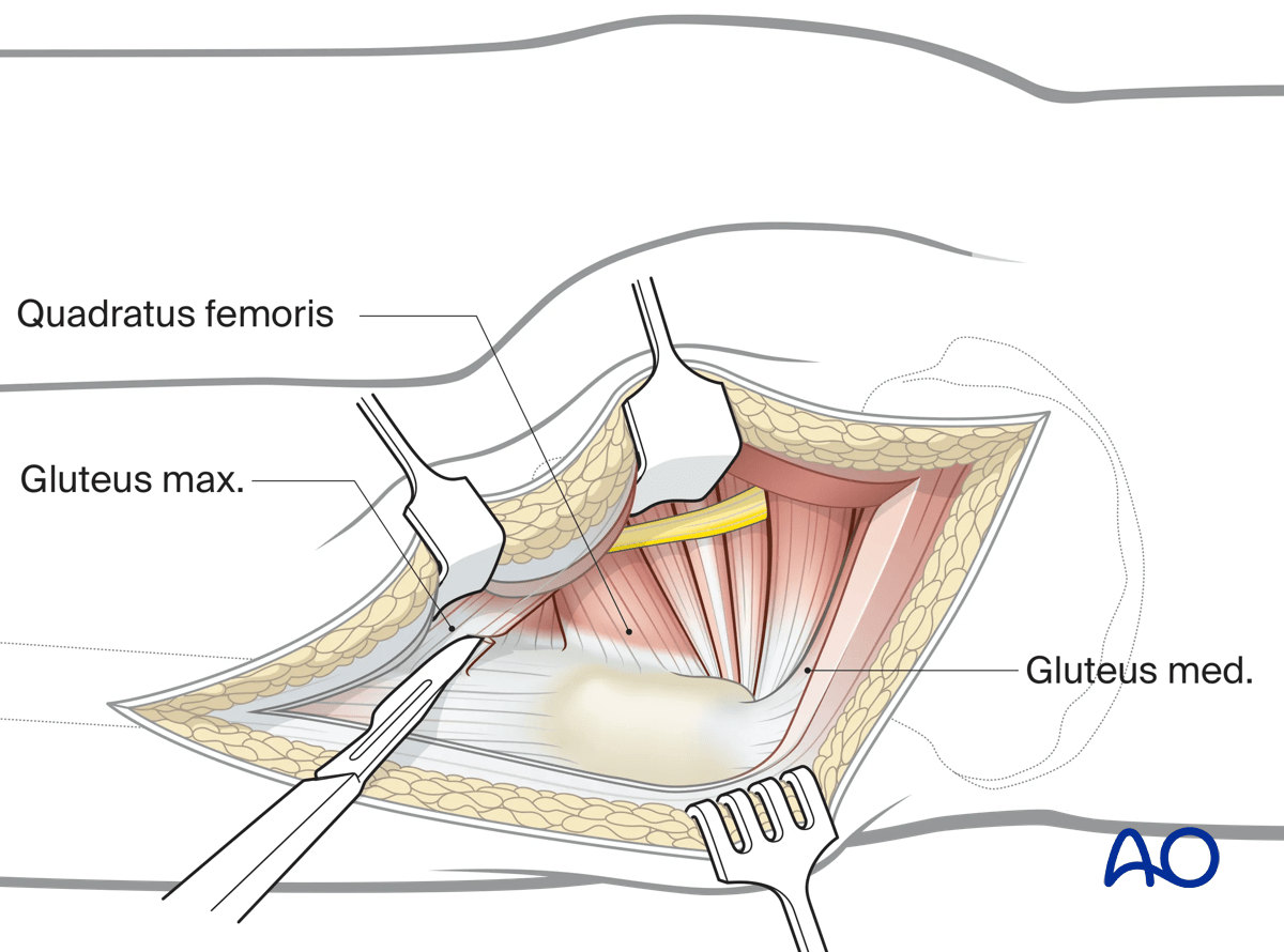 Illustration of Kocher-Langenbeck approach: detaching gluteus maximus for easier mobilization.