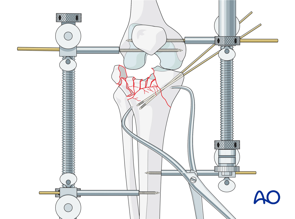 ORIF - Conventional plating, preliminary reduction