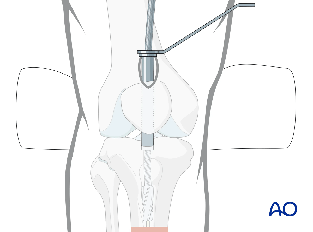 Suprapatellar intramedullary nailing, Reaming and determination of nail diameter