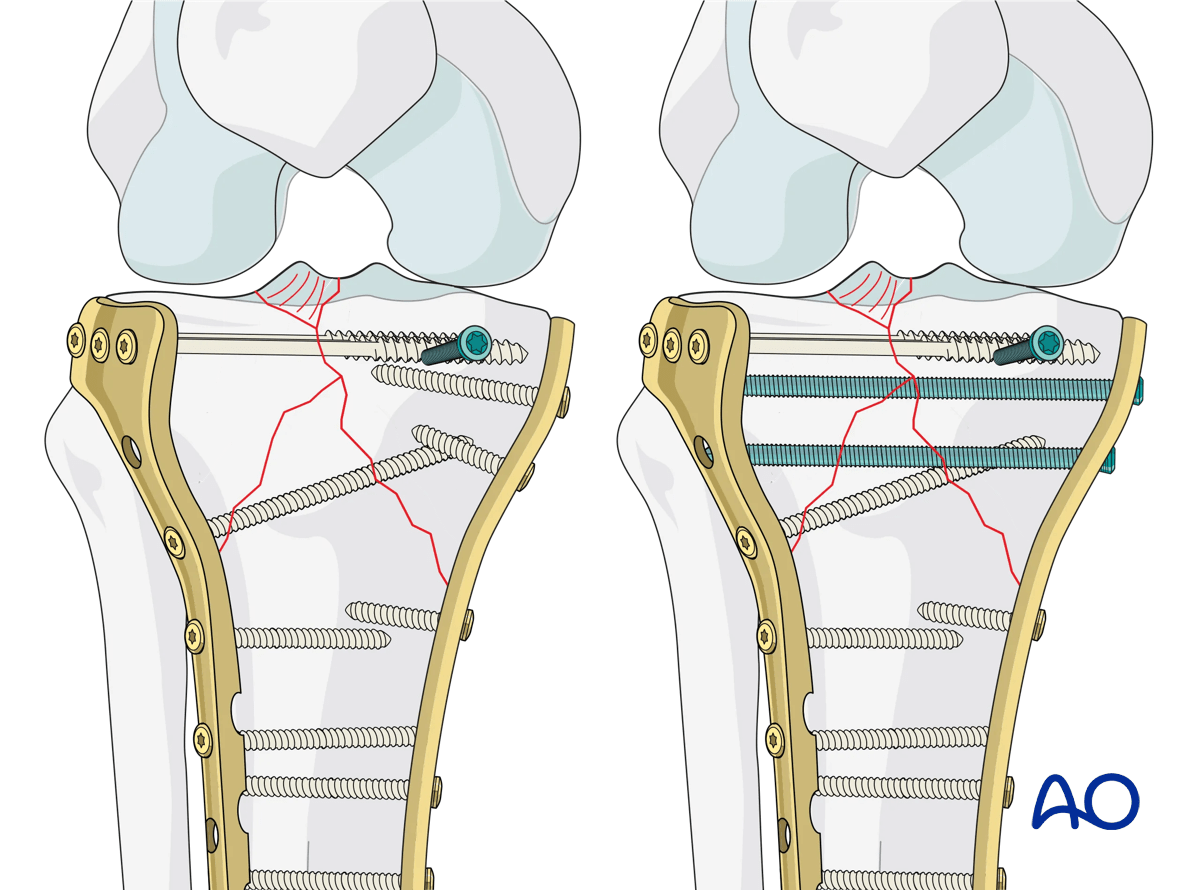 Proximal tibia - Complete articular fracture with fragmentary medial plateau: final osteosynthesis