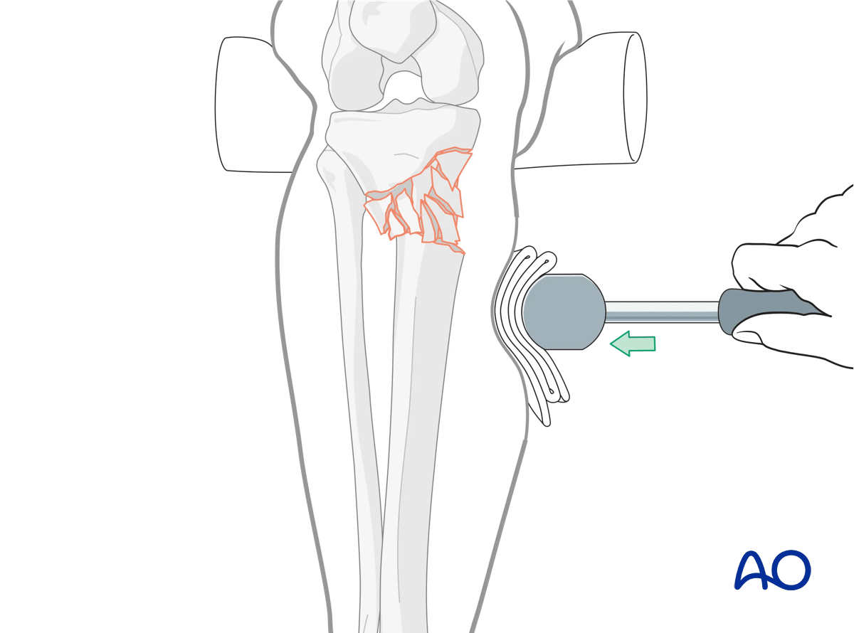 Proximal tibia: Wedge or multifragmentary extraarticular fracture Angular stable plating – indirect reduction